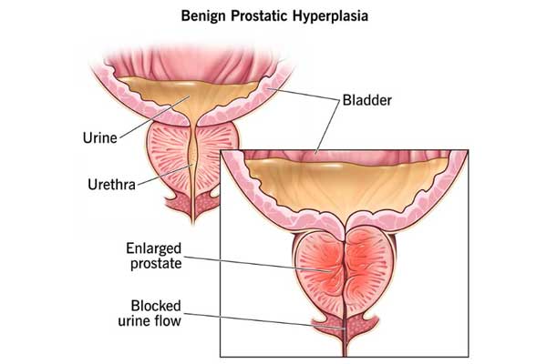 Benign Prostatic Hyperplasia