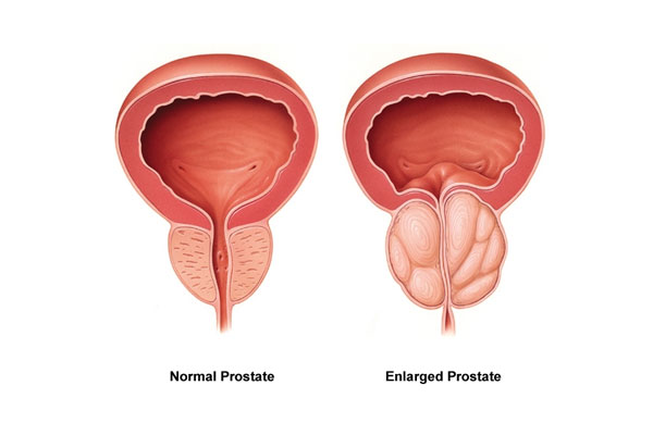 Enlarged Prostate