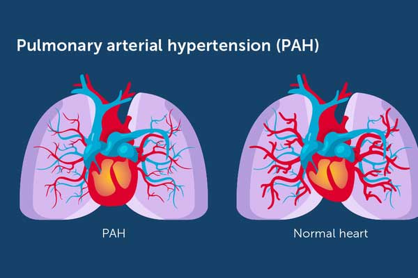 Pulmonary Arterial Hypertension